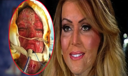 Người phụ nữ lấy lại khuôn mặt thần kỳ sau 30 tháng bị đốt cháy