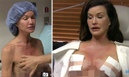 Công khai hình ảnh phẫu thuật ngực của cựu siêu mẫu Janice Dickinson
