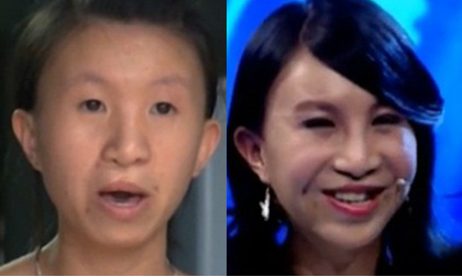  Sự thay đổi diện mạo đến khó tin của cô gái Việt nặng 30kg, gương mặt như cụ bà 