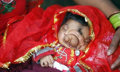 Em bé mới sinh có mũi 'vòi voi' được tôn thờ như thần thánh