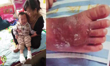Bé trai 2 tuổi bỏng rộp hai chân vì bị cô giáo rửa nước nóng