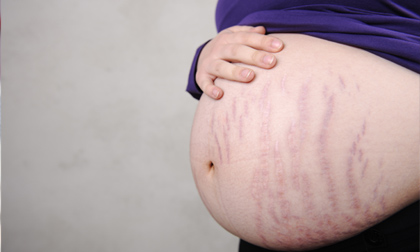 Trị vết rạn bụng khi mang thai và sau sinh con