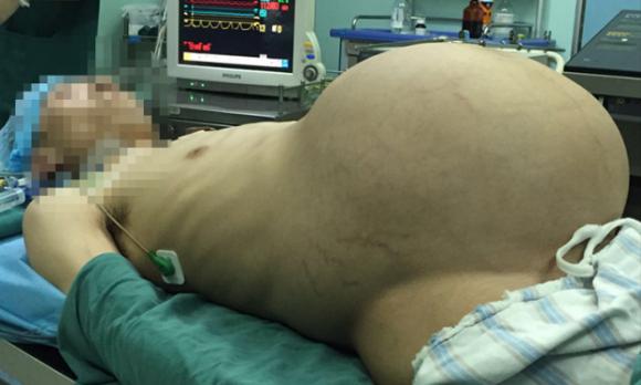 Người đàn ông mang khối u nặng hơn 15kg ở bụng như chửa 0