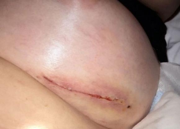 Cô gái Anh bị nổ ngực suýt chết vì ham phẫu thuật giá rẻ 3