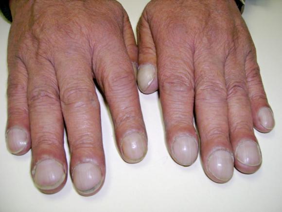 3 dấu hiệu trên móng tay tiết lộ bệnh tuyệt đối không nên bỏ qua 1