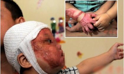 Xót xa bé một tuổi bị bỏng nặng vì ngã vào nồi nước nóng