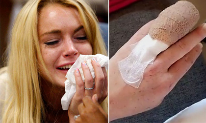 Lindsay Lohan bị tai nạn đứt lìa nửa ngón tay