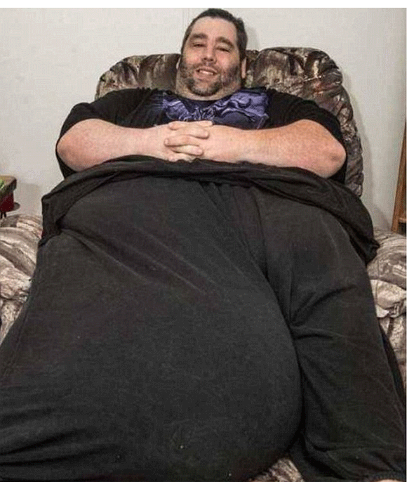 Phẫu thuật thành công cho người đàn ông có tinh hoàn khổng lồ nặng hơn 55kg