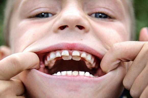 Cậu bé 8 tuổi có đến 4 hàm răng