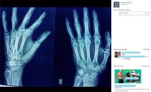 Phim chụp X quang bàn tay bị gãy của Venera Pratova cũng được đăng tải làm bằng chứng.