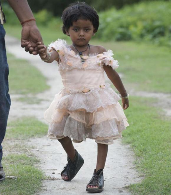 Những đứa trẻ sinh ra với bốn chân bốn tay ở Ấn Độ