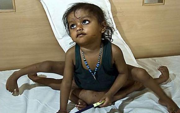 Những đứa trẻ sinh ra với bốn chân bốn tay ở Ấn Độ
