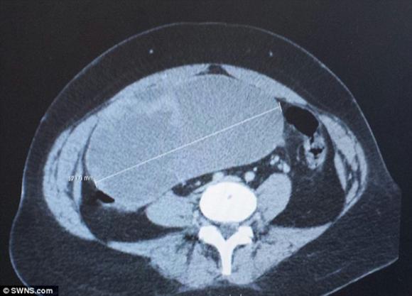 Đi khám dạ dày bất ngờ phát hiện khối u to bằng quả bóng trong bụng