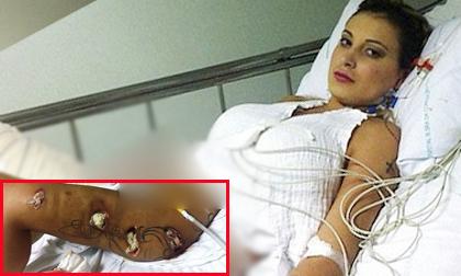 Nữ MC Brazil thủng chân, nguy cơ mất mạng vì độn vòng ba