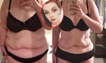 Cô gái kiến nghị Bộ trưởng Y tế để được cắt da thừa sau khi giảm 55 kg