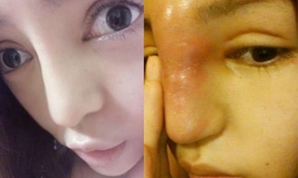 Cô gái Trung Quốc mũi to như vòi voi sau khi 'dao kéo'