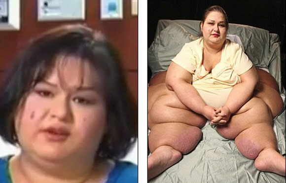 cô gái 453kg phẫu thuật giảm béo 6