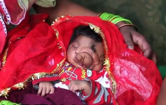 Bé gái vừa sinh ra đã có vòi voi ngay trên khuôn mặt
