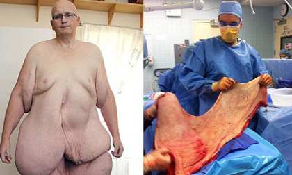 Người đàn ông từng béo nhất thế giới cắt bỏ da thừa