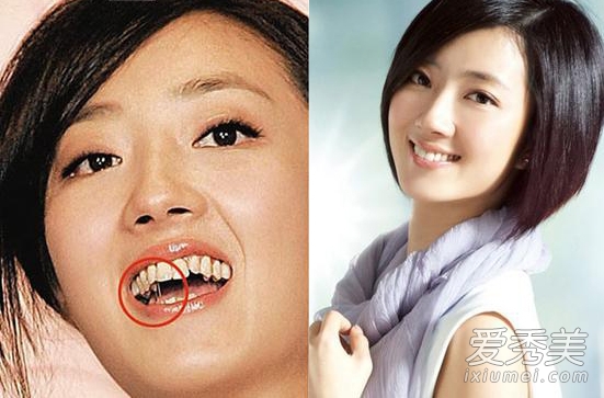 hàm răng kinh dị của sao Hoa ngữ 2