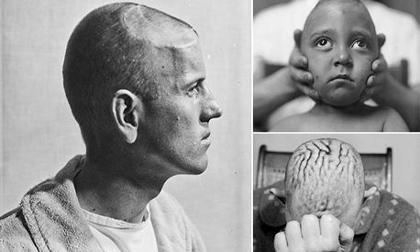 Hình ảnh gây ám ảnh về phẫu thuật não những năm 1900