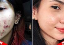 Tuyệt chiêu trị mụn của cô gái Việt được khen ngợi hết lời trên báo nước ngoài Tuyệt chiêu trị mụn của cô gái Việt được khen ngợi hết lời trên báo nước ngoài