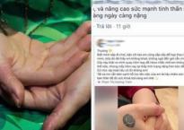 Hương Tràm tự bóc da tay đến nỗi rỉ máu: Bác sĩ cảnh báo về hội chứng vô cùng nguy hiểm Hương Tràm tự bóc da tay đến nỗi rỉ máu: Bác sĩ cảnh báo về hội chứng vô cùng nguy hiểm
