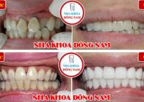 Bọc răng sứ không cần mài răng, có đúng sự thật? Bọc răng sứ không cần mài răng, có đúng sự thật?
