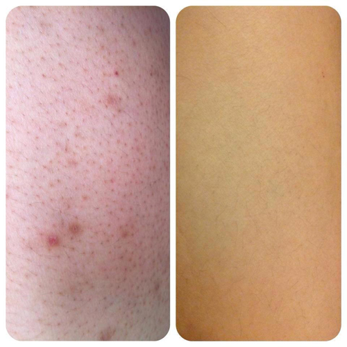 Spa Jollie D, viêm nang lông, Điều trị viêm nang lông, Thẩm mỹ viện điều trị viêm nang lông