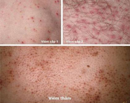 Spa Jollie D, viêm nang lông, Điều trị viêm nang lông, Thẩm mỹ viện điều trị viêm nang lông