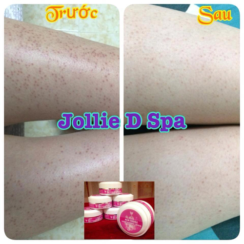 Spa Jollie D, viêm nang lông, Điều trị viêm nang lông, Thẩm mỹ viện điều trị viêm nang lông