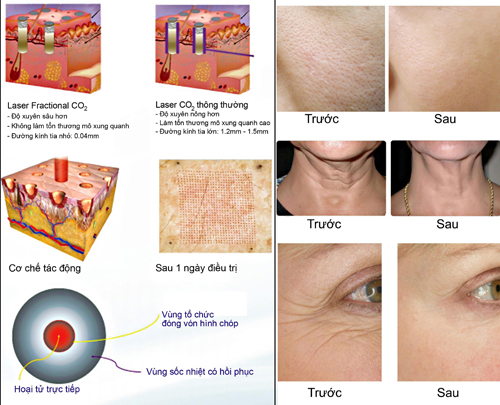 Huy Khánh, Thẩm mỹ viện Mailisa, Trị sẹo, Trị sẹo công nghệ cao, Trẻ hóa da