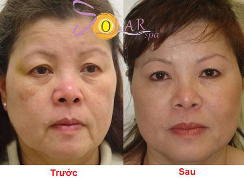 Solar Spa, Căng da mặt không phẫu thuật, Căng da trẻ hóa, Trẻ hóa da