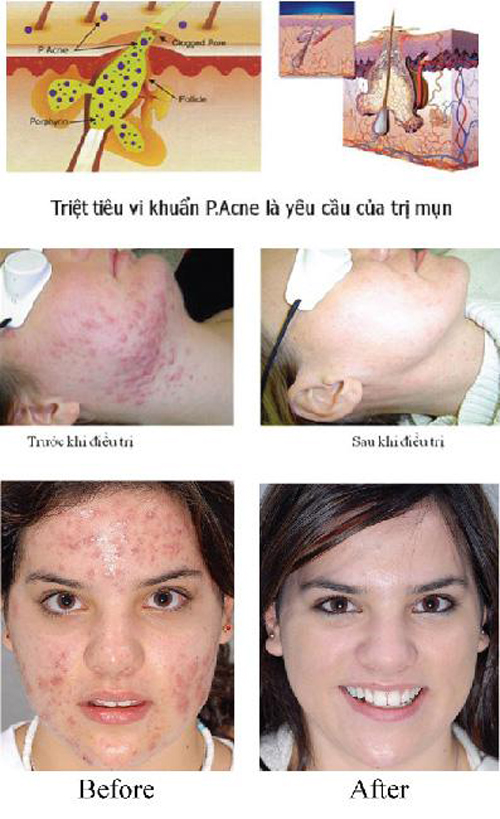 Trị mụn, Trị mụn công nghệ cao, Spa Trị mụn, Spa Ngọc Trinh