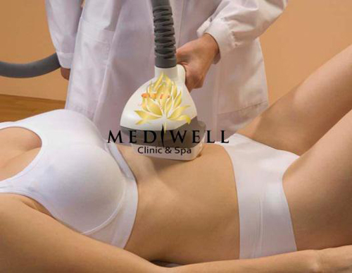 mediwell spa, Hủy mỡ công nghệ cao, Hủy mỡ thừa