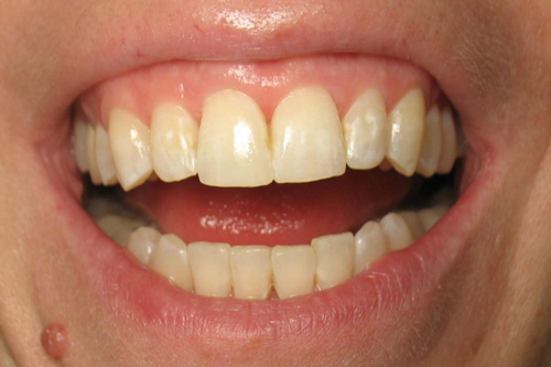 Phẫu thuật răng hô, Hollywood Plastic Surgery, Phẫu thuật cắt xương hàm nội soi 3D, Hàm răng đẹp