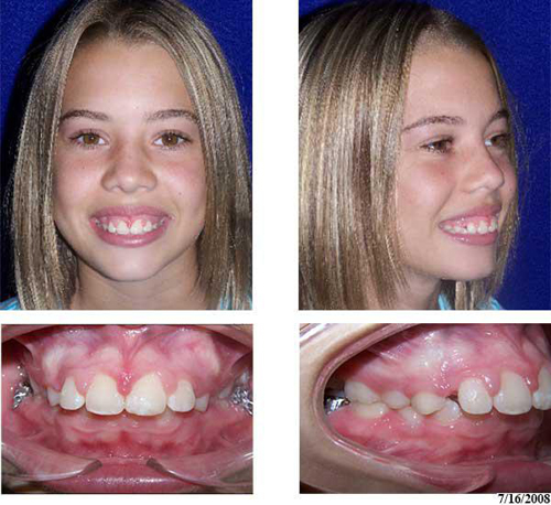 Phẫu thuật răng hô, Hollywood Plastic Surgery, Phẫu thuật cắt xương hàm nội soi 3D, Hàm răng đẹp
