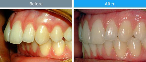 Phẫu thuật răng hô, Hollywood Plastic Surgery, Phẫu thuật cắt xương hàm nội soi 3D, Hàm răng đẹp