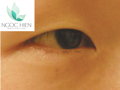 Phẫu thuật chỉnh hình góc mắt, Phẫu thuật mắt, Viện thẩm mỹ Ngọc Hiền, Tạo hình mí mắt công nghệ Hàn Quốc