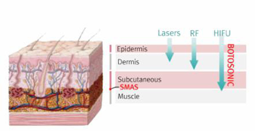 Mediwell spa, Trẻ hóa da, Trẻ hóa HIFU, Trẻ hóa da một lần duy nhất