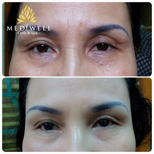 Mediwell spa, Trẻ hóa da, Trẻ hóa HIFU, Trẻ hóa da một lần duy nhất