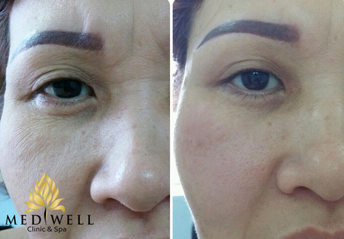 Mediwell spa, Trẻ hóa da, Trẻ hóa HIFU, Trẻ hóa da một lần duy nhất