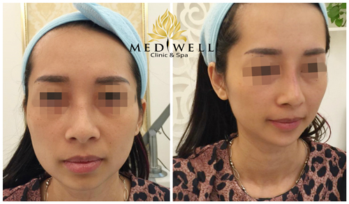 Mediwell spa, phẫu thuật mặt V-line, Phẫu thuật mũi S-line, Phẫu thuật thẩm mỹ