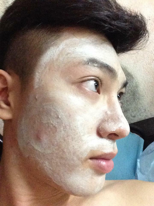 Trị mụn, Trị mụn thành công sau 2 tháng, Cleaning Mask, Spa Ngọc Ánh Kim