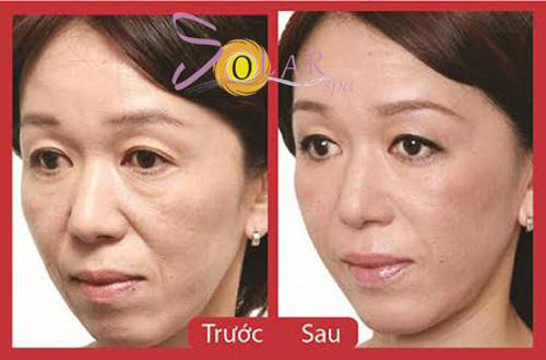 Solar Spa, Trẻ hóa da, Căng da mặt, Solar Spa khuyến mại