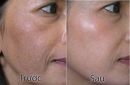 Trị nám, Trị tàn nhang, Thẩm mỹ viện Bích Hoà