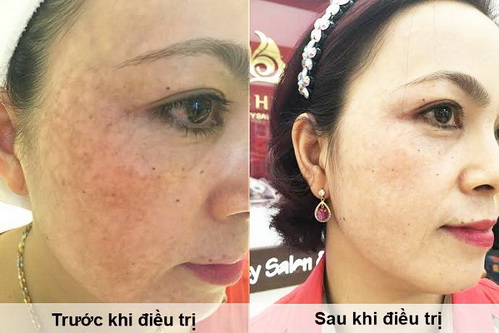 Trị nám, Trị tàn nhang, Thẩm mỹ viện Bích Hoà