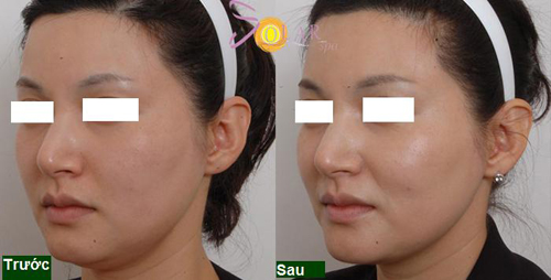 Solar Spa, Trẻ hóa da mặt, Trẻ hóa da mặt 1 lần duy nhất không phẫu thuật