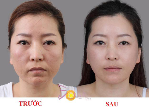 Trẻ hóa da mặt, Trẻ hóa da mặt không phẫu thuật, Solar spa