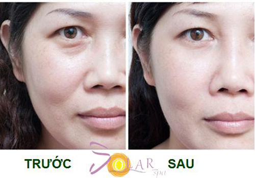 Trẻ hóa da mặt, Trẻ hóa da mặt không phẫu thuật, Solar spa